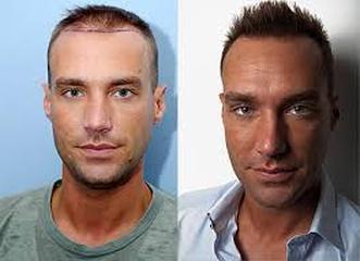 A Fue Hair Transplant Could Be The Best Choice For You - HAIR TRANSPLANT  OTTAWA